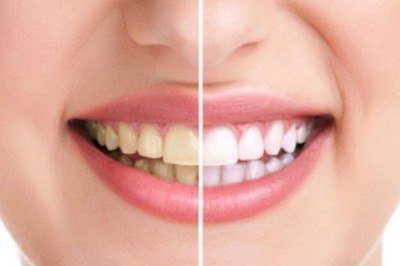 อยากฟันขาวต้องกินอะไรดีนะ