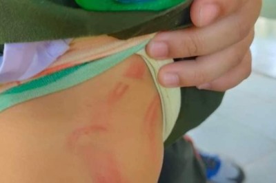 เต็มตัว! เด็กน้อยถูกพี่เลี้ยงทำร้าย ฟาดไม่ยั้งมือทิ้งรอยช้ำต่างหน้าไปทั่วร่างกาย