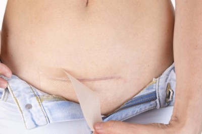 วิธีลด ความเจ็บปวด จากแผลผ่าตัด