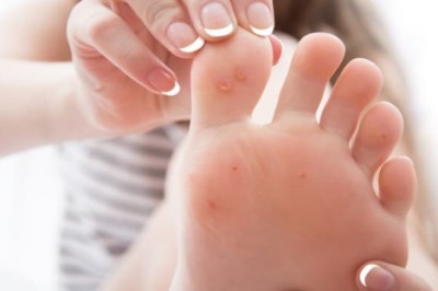 สูตรแก้ตาปลาที่เท้า