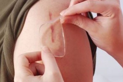 รอยแผลเป็นกับปัญหาคาใจ