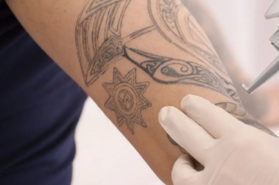 อยากลบรอยสักต้องทำอย่างไร