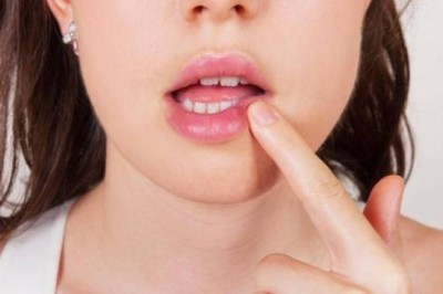 วิธีป้องกันไม่ให้เป็นร้อนใน