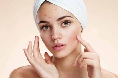 วิธีเร่งให้สิวยุบได้เร็วขึ้น