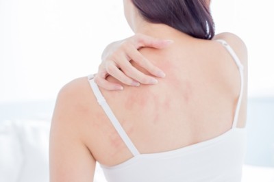 ผื่นลมพิษแก้ได้ง่ายนิดเดียว