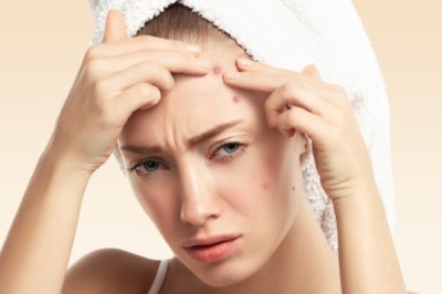 รวมวิธีกำจัดสิวช่วงวันนั้นของเดือน