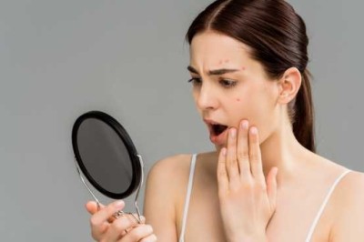 สาเหตุของการเกิดสิว