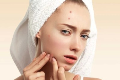 กำจัดสิวผดให้หมดไปจากใบหน้า