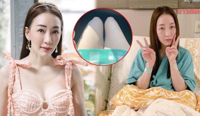 เทียบให้เห็นชัดๆ ผู้จัด ตู่ ปิยวดี เผยภาพขาขวาลีบลงหลังผ่าหัวเข่า