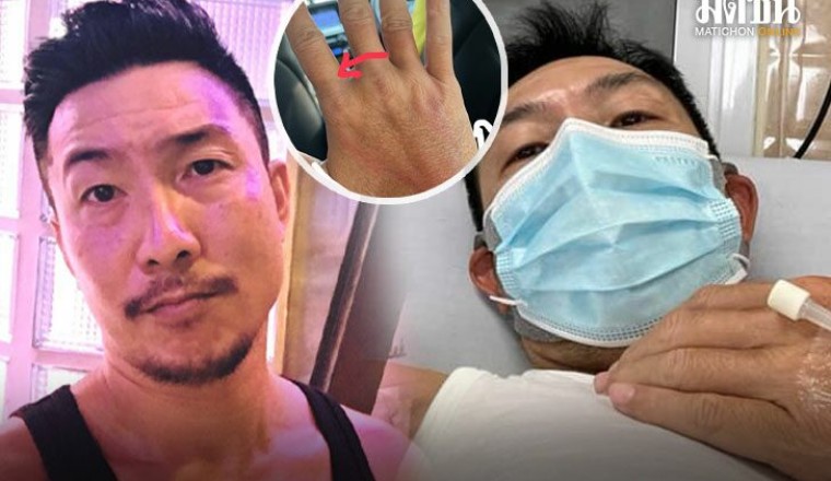 ‘โจอี้ บอย’ ถูกแตนต่อย แพ้รุนแรง เล่านาทีเอามือปัด เจ็บปวดจี้ดถึงสมอง หายใจขัด-ลมพิษขึ้น