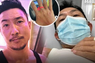 ‘โจอี้ บอย’ ถูกแตนต่อย แพ้รุนแรง เล่านาทีเอามือปัด เจ็บปวดจี้ดถึงสมอง หายใจขัด-ลมพิษขึ้น