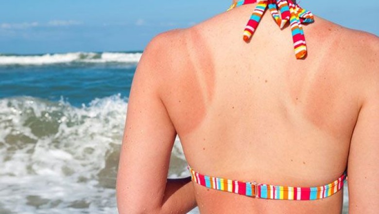 ผิวไหม้เพราะแสงแดดทำไงดี