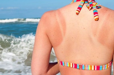 ผิวไหม้เพราะแสงแดดทำไงดี