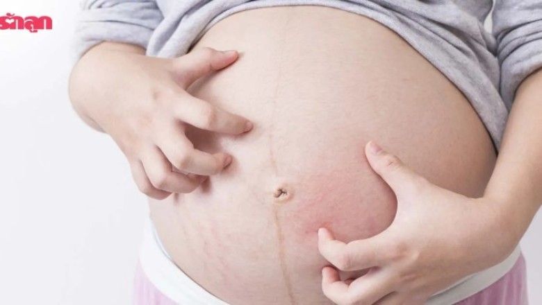 5 วิธีช่วยแม่ท้องหายคัน