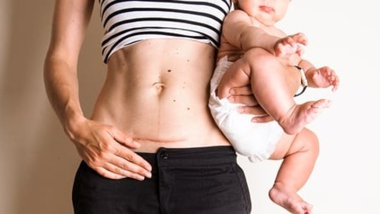 เคล็ดลับหลังคลอดหน้าท้องแบนราบ