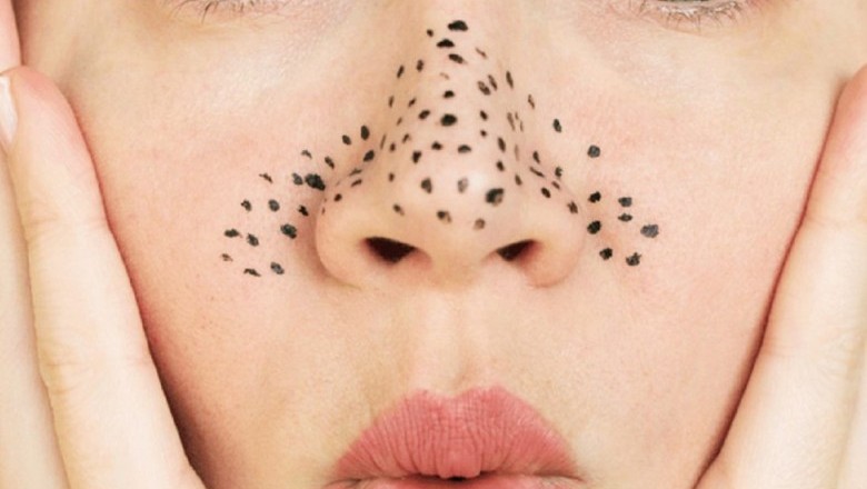 สูตรขจัดสิวหัวดำ