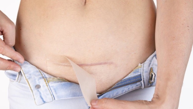 วิธีลด ความเจ็บปวด จากแผลผ่าตัด