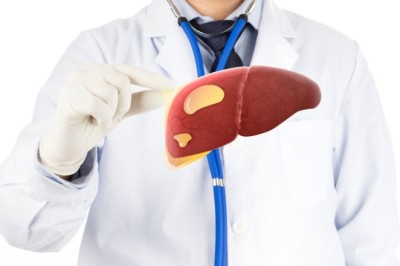 ตับถูกไขมันเกาะ ไม่ใช่แค่เพราะดื่มเหล้า