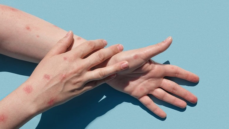 แนะ 4 วิธี ป้องกันโรคฝีดาษลิง