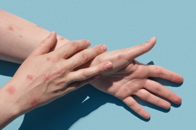 แนะ 4 วิธี ป้องกันโรคฝีดาษลิง