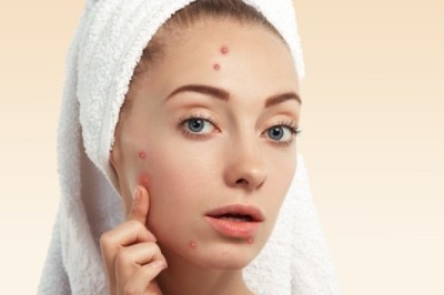 สิวยุบด้วยว่านหางจระเข้