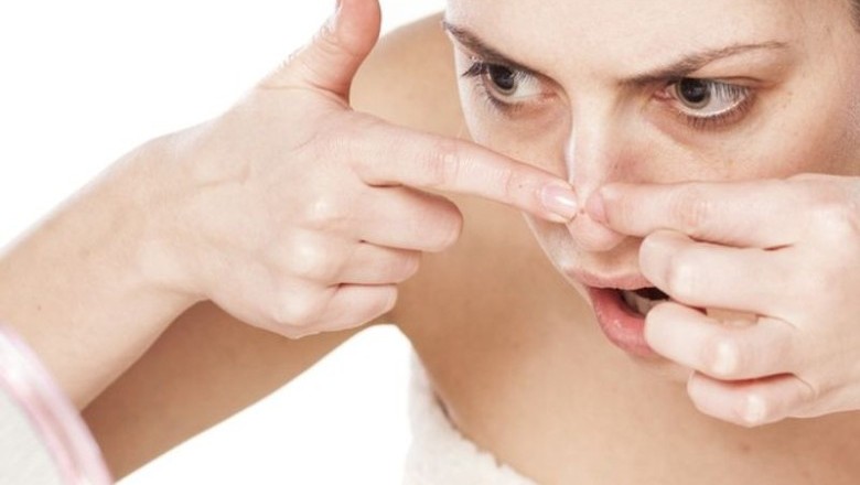 วิธีขจัดสิวเสี้ยนอย่างง่ายๆ