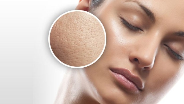 รูขุมขนกว้างก็เล็กลงได้ ง่ายนิดเดียว