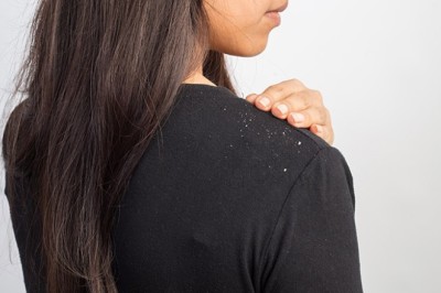 เคล็ดลับขจัดรังแคบนหนังศีรษะ