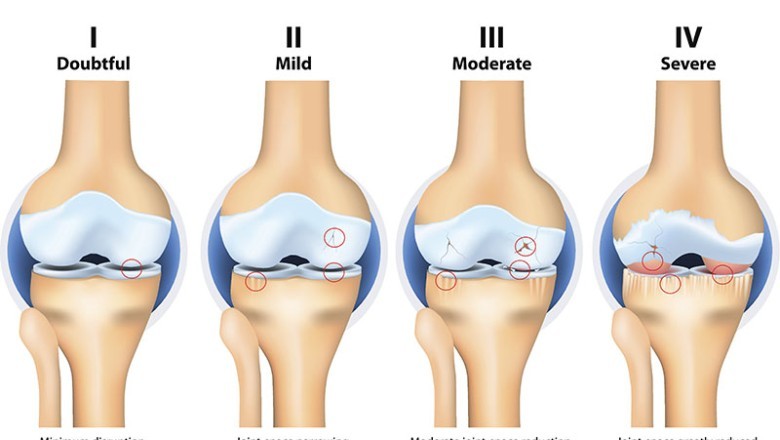 เสียงครวญจาก "ข้อต่อ"
