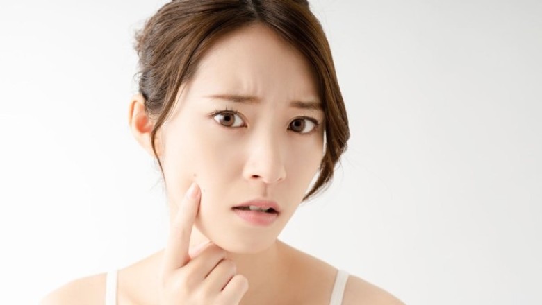 สูตรแก้ปัญหาสิวฝ้า