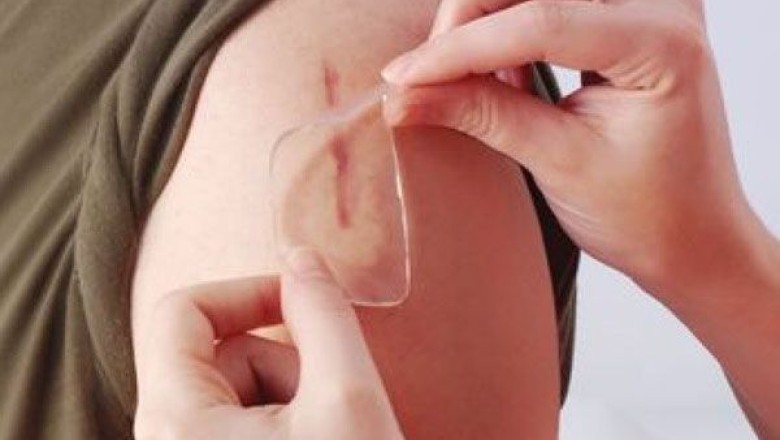 รอยแผลเป็นกับปัญหาคาใจ