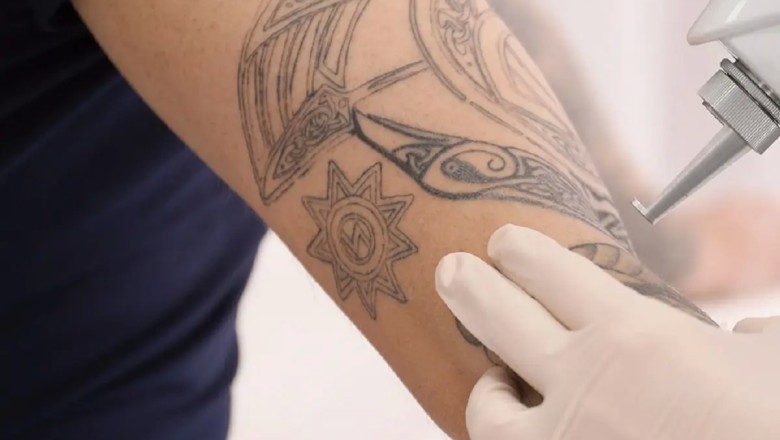 อยากลบรอยสักต้องทำอย่างไร