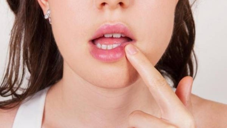 วิธีป้องกันไม่ให้เป็นร้อนใน