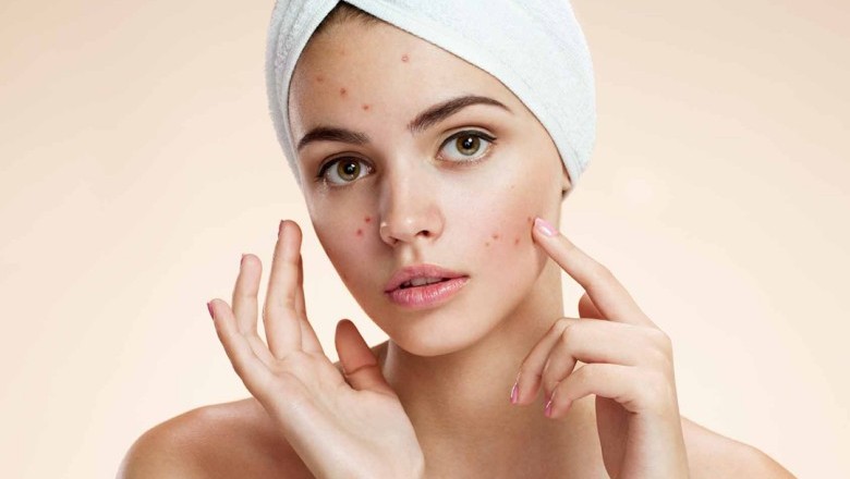 วิธีเร่งให้สิวยุบได้เร็วขึ้น