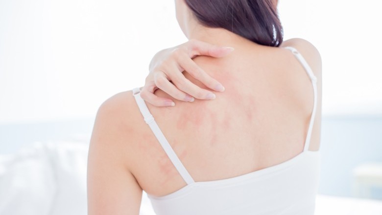 ผื่นลมพิษแก้ได้ง่ายนิดเดียว