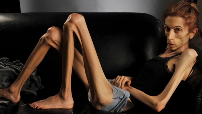 อาการที่บอกว่าคุณเป็นโรคอะนอเร็กเซีย