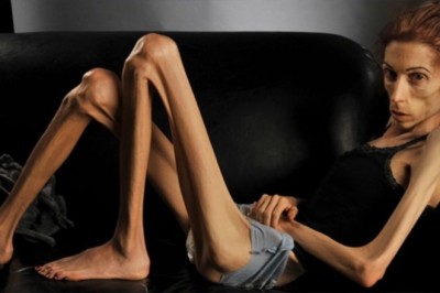 อาการที่บอกว่าคุณเป็นโรคอะนอเร็กเซีย