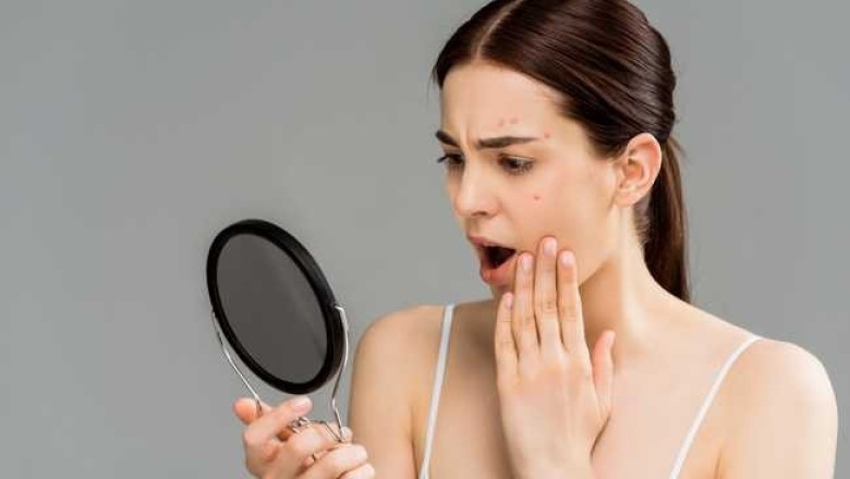 สาเหตุของการเกิดสิว