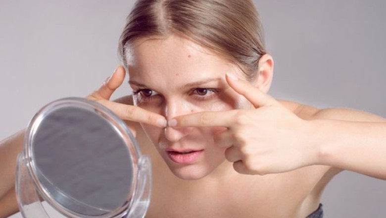 ดื่มน้ำอัดลมแล้วทำให้เกิดสิวจริงหรือ