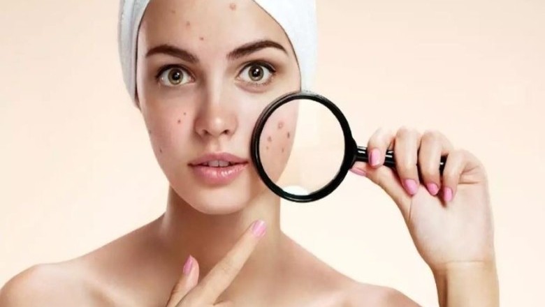 รับมือกับจุดด่างดำ